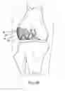 Fig. 05 - Stable cartilage defect repair plug