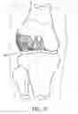 Fig. 06 - Stable cartilage defect repair plug