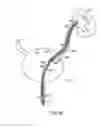 Fig. 06 - Self-retaining stent