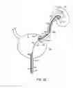 Fig. 07 - Self-retaining stent