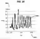 Fig. 19 - Gui With Trend Analysis for an Implantable Restriction Device and a Data Logger