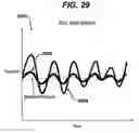 Fig. 27 - Gui With Trend Analysis for an Implantable Restriction Device and a Data Logger