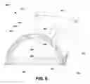 Fig. 07 - ORTHOPEDIC IMPLANT