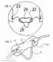 Fig. 03 - Eyebrow stencil positioning apparatus with stencil visualization lines