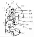 Fig. 01 - Long term ambulatory intro-aortic balloon pump with percutaneous access device