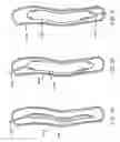 Fig. 02 - Long term ambulatory intro-aortic balloon pump with percutaneous access device
