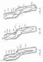 Fig. 04 - Long term ambulatory intro-aortic balloon pump with percutaneous access device