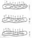 Fig. 05 - Long term ambulatory intro-aortic balloon pump with percutaneous access device