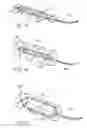 Fig. 08 - Long term ambulatory intro-aortic balloon pump with percutaneous access device
