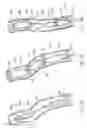 Fig. 09 - Long term ambulatory intro-aortic balloon pump with percutaneous access device