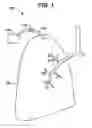 Fig. 02 - PULMONARY PLEURAL STABILIZER