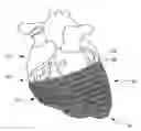 Fig. 01 - HEART FAILURE TREATMENT DEVICE AND METHOD