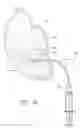Fig. 17 - HEART FAILURE TREATMENT DEVICE AND METHOD