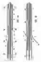 Fig. 11 - Biopsy anchor device with cutter