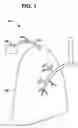 Fig. 02 - Variable parietal/visceral pleural coupling