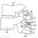 Fig. 01 - Interspinous spacer