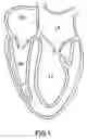 Fig. 02 - Treating Valvular Insufficiency