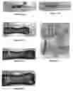 Fig. 07 - Intramedullary fixation device for fractures