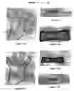 Fig. 08 - Intramedullary fixation device for fractures