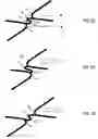 Fig. 07 - Flexible stent with elevated scaffolding properties