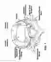 Fig. 02 - Method for treating herniated discs
