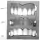 Fig. 01 - METHOD AND APPARATUS FOR TEMPORARY DENTAL VENEERS