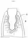 Fig. 08 - Artificial socket bone