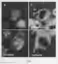 Fig. 07 - Method of judging grade of malignancy of carcinoma cell using ATBF-1