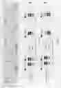Fig. 43 - Method of judging grade of malignancy of carcinoma cell using ATBF-1