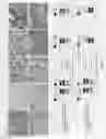 Fig. 45 - Method of judging grade of malignancy of carcinoma cell using ATBF-1