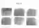 Fig. 06 - Malignant tumor-inhibiting preparation comprising Des A fibrin