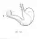 Fig. 42 -  DEVICE FOR INSUFFLATING THE INTERIOR OF A GASTRIC CAVITY OF A PATIENT