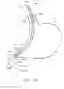 Fig. 51 -  DEVICE FOR INSUFFLATING THE INTERIOR OF A GASTRIC CAVITY OF A PATIENT