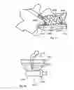 Fig. 40 - Methods for utilizing vibratory energy to weld, stake and/or remove implants