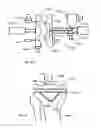 Fig. 41 - Methods for utilizing vibratory energy to weld, stake and/or remove implants