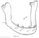 Fig. 02 - Magnetically implantable prosthetic device and method to shorten healing time, enhance bone fusion, and retard bacterial growth