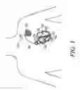 Fig. 02 - Lead assembly having a tethered sensor and methods related thereto