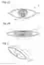 Fig. 02 - Penile compression device