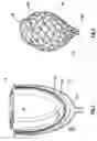 Fig. 06 - Device for proactive modulation of cardiac strain patterns