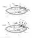 Fig. 07 - Apparatus and method of enhancing sexual satisfaction via an implantable vibrating device