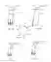 Fig. 08 - Illuminated telescoping cannula