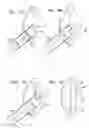 Fig. 07 - Injectable intraocular implants