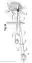 Fig. 49 - Method and apparatus for the treatment of the intervertebral disc annulus