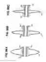 Fig. 71 - Method and apparatus for the treatment of the intervertebral disc annulus