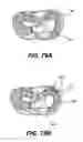 Fig. 85 - Method and apparatus for the treatment of the intervertebral disc annulus