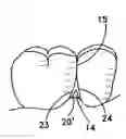 Fig. 01 - Reshapable device for fixation at a dental site