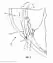 Fig. 02 - METHODS, APPARATUSES, AND SYSTEMS FOR REDUCING INTRAOCULAR PRESSURE AS A MEANS OF PREVENTING OR TREATING OPEN-ANGLE GLAUCOMA
