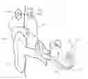 Fig. 01 - Pre-curved cochlear implant electrode array
