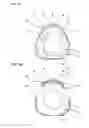 Fig. 08 - Fuel damper fixing clip