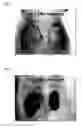 Fig. 04 - SUSTAINED RELEASE FILM FORMULATION FOR HEALING WOUND COMPRISING EPIDERMAL GROWTH FACTOR